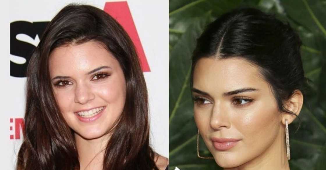 Celebrity nose jobs Celebrity nose jobs