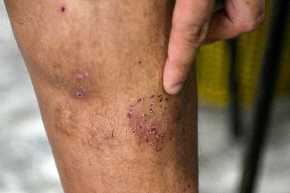 A victim of a Chinese scamming gang shows a scar on his leg after he was tortured A victim of a Chinese scamming gang shows a scar on his leg after he was tortured