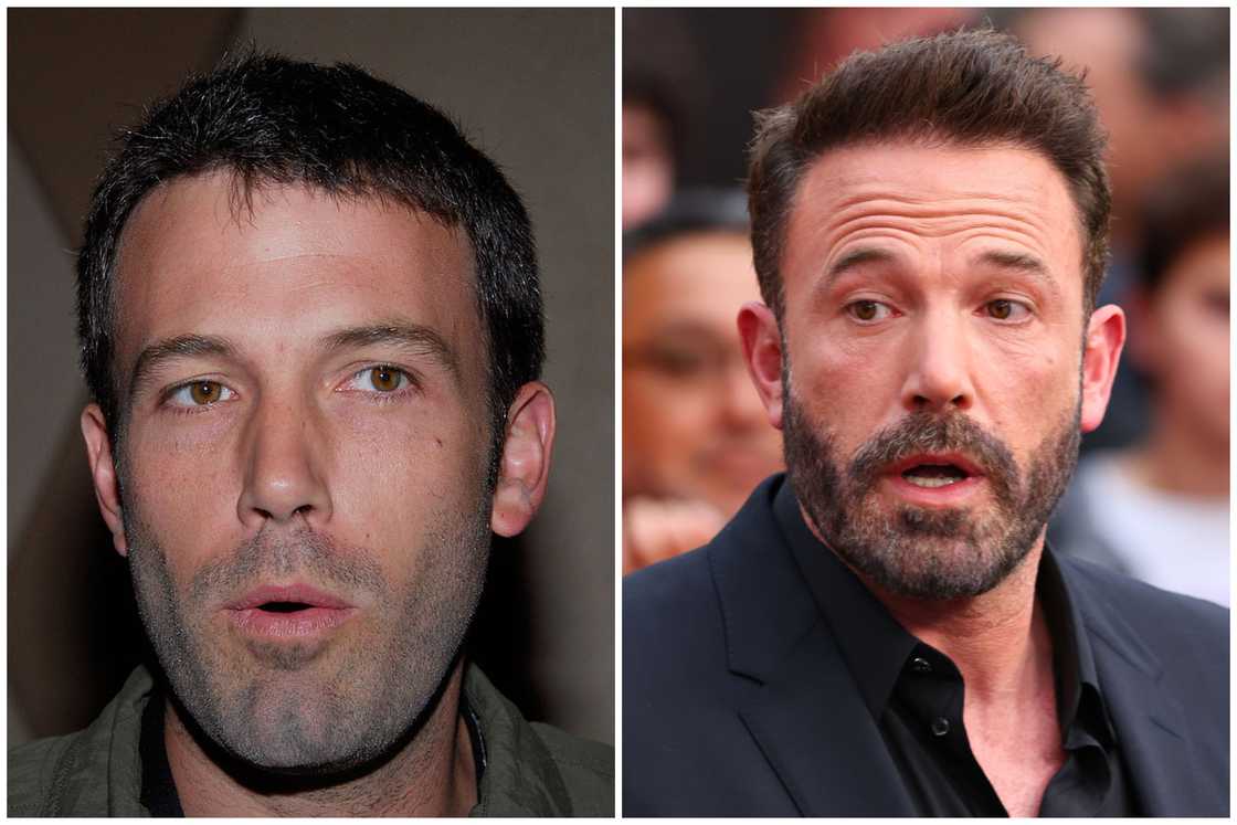 Hair transplant celebrities before and after