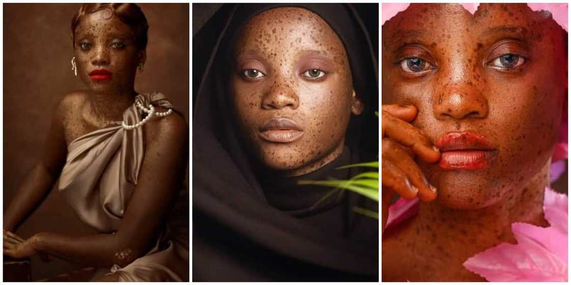 Meet the beautiful 20-year-old Nigerian model with skin condition Meet the beautiful 20-year-old Nigerian model with skin condition