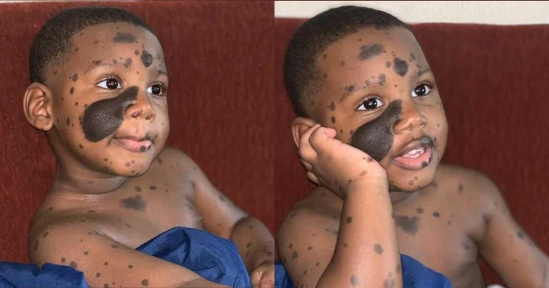 Adorable photos of a boy looking cute with his birthmarks go viral Adorable photos of a boy looking cute with his birthmarks go viral