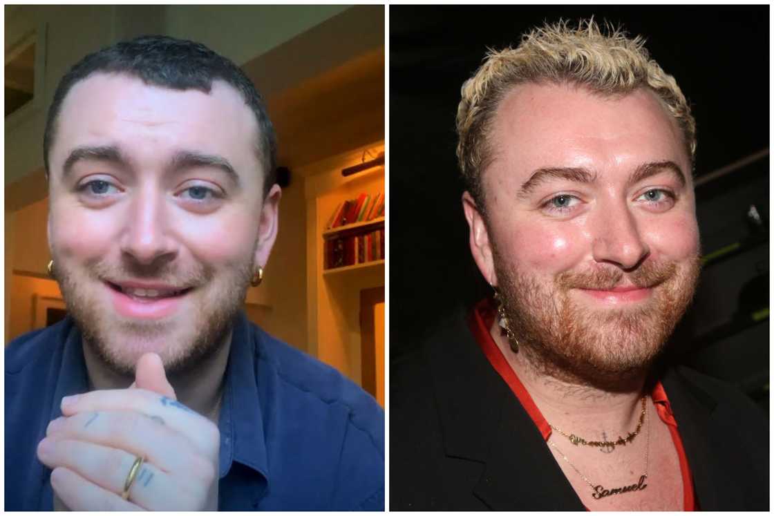 Hair transplant celebrities before and after Hair transplant celebrities before and after