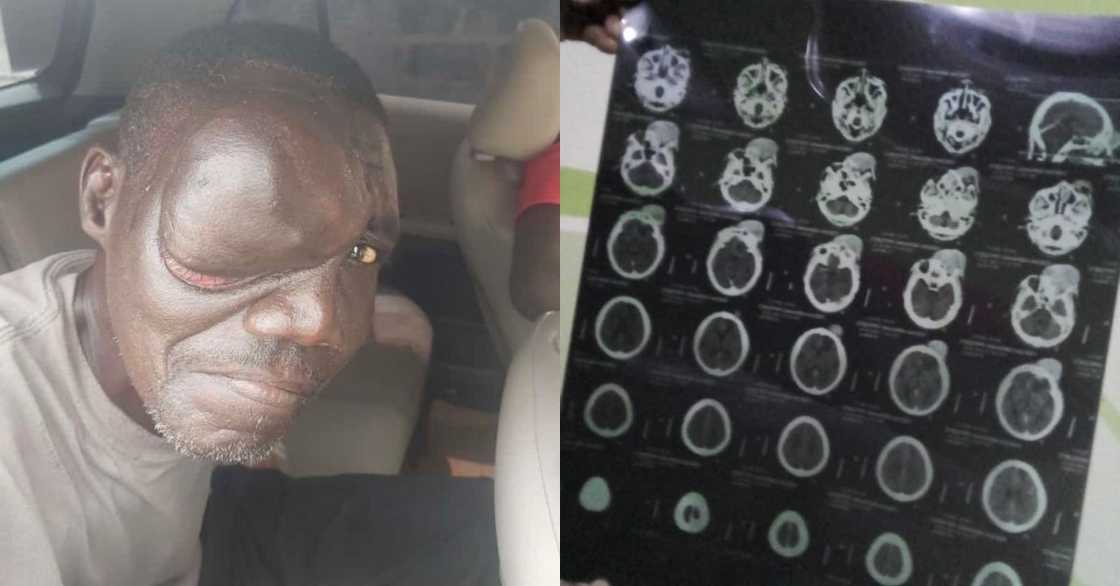 54-year-old homeless man develops tumour on his eye; needs money for surgery