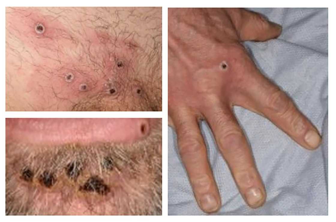 Most of the new monkeypox cases have been recorded in Europe Most of the new monkeypox cases have been recorded in Europe