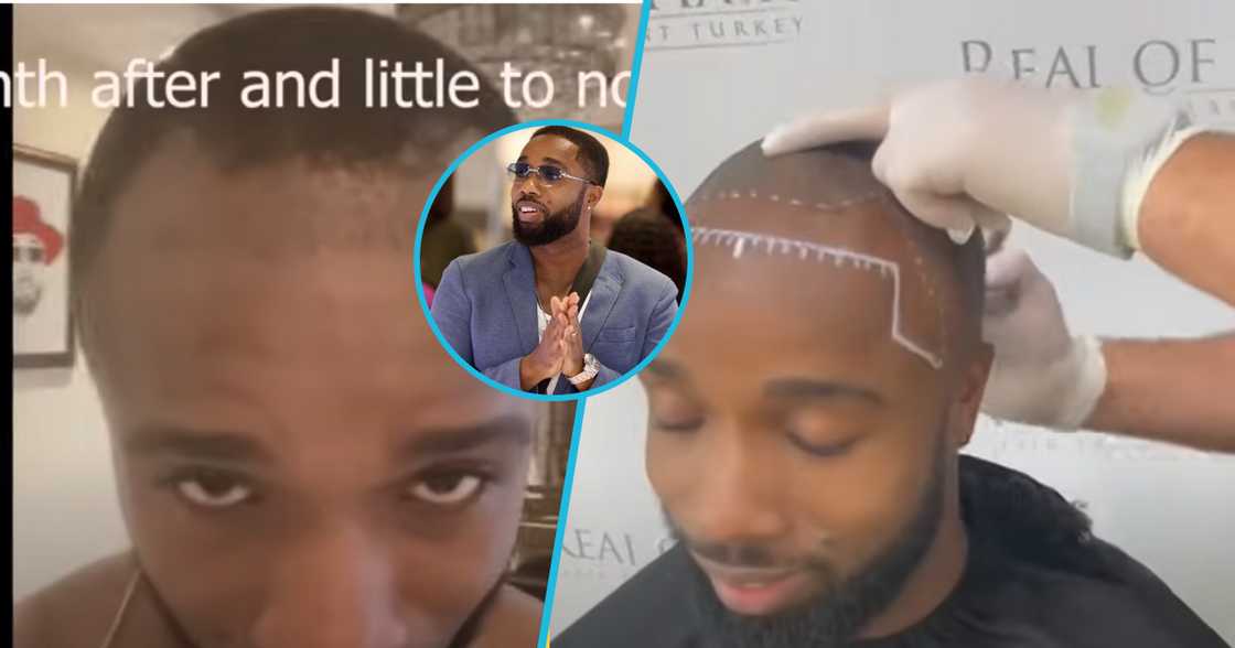 Ghanaian actor Harold Amenyah shows off his new look after his hair transplant in Turkey Ghanaian actor Harold Amenyah shows off his new look after his hair transplant in Turkey