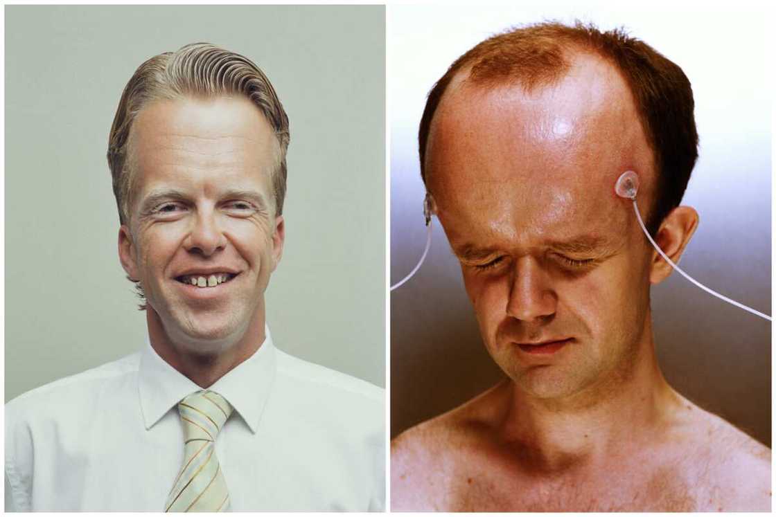 The Mystery Of Who Has The Biggest Forehead In The World