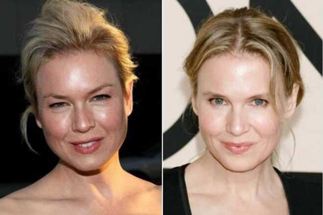 Celebrity blepharoplasty before and after Celebrity blepharoplasty before and after