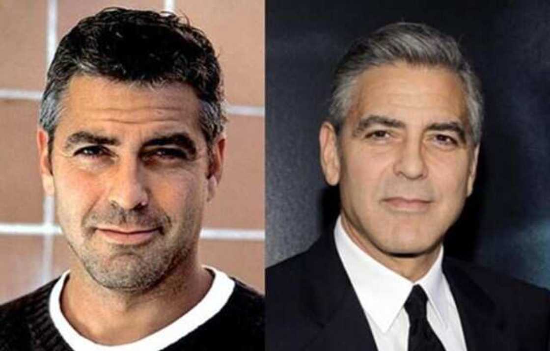 celebrity blepharoplasty before and after celebrity blepharoplasty before and after