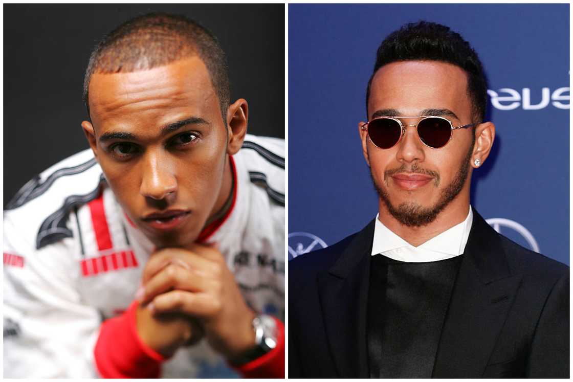 Hair transplant celebrities before and after Hair transplant celebrities before and after