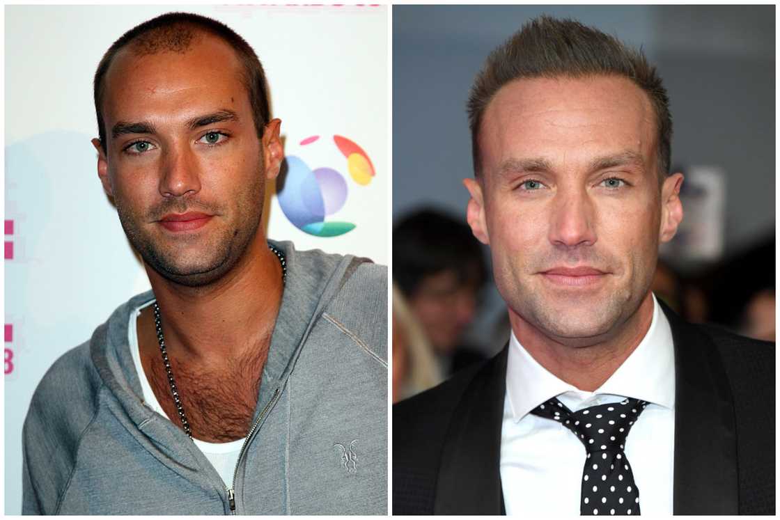 Hair transplant celebrities before and after Hair transplant celebrities before and after