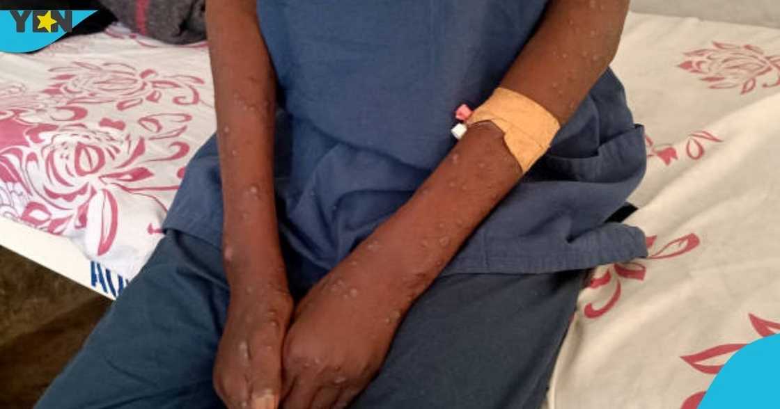 Mpox, Monkey pox in Ghana, Increased cases, One dead Mpox, Monkey pox in Ghana, Increased cases, One dead