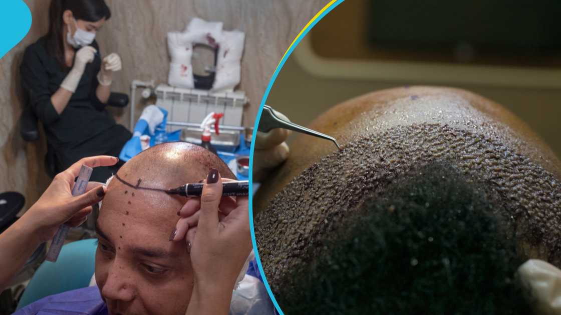 University Of Ghana Medical Centre is set to start performing hair transplants