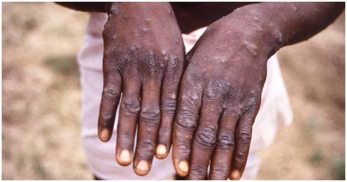 Monkeypox hands
