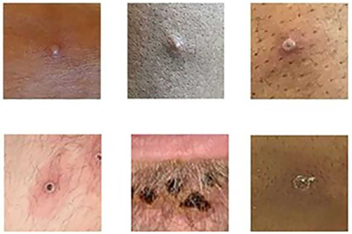 A picture made available by the UK Health Security Agency showing a range of monkeypox lesions A picture made available by the UK Health Security Agency showing a range of monkeypox lesions