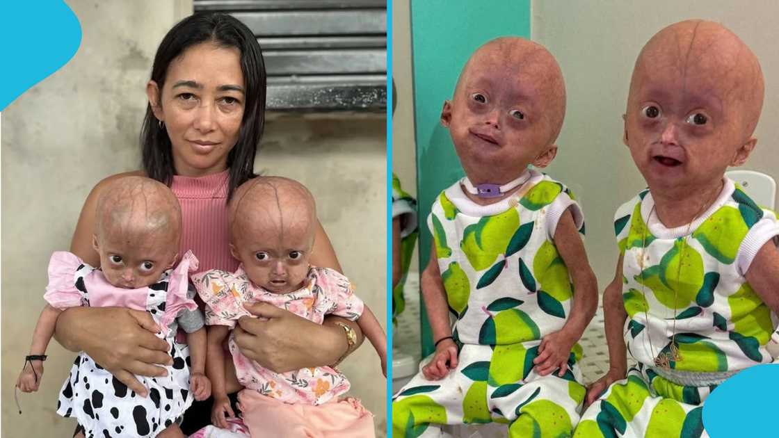 elis lima carneiro, elis lima carneiro dies, progeria twins, eloá lima carneiro, social media star dies, hutchinson-gilford progeria syndrome elis lima carneiro, elis lima carneiro dies, progeria twins, eloá lima carneiro, social media star dies, hutchinson-gilford progeria syndrome