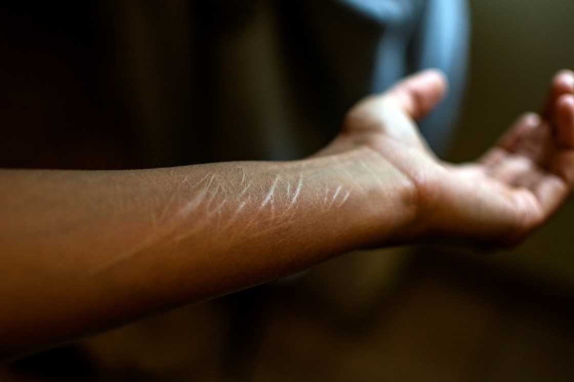 A university student shows the scars left by cuts she inflicted on herself in a suicide attempt in the city of Merida, Venezuela A university student shows the scars left by cuts she inflicted on herself in a suicide attempt in the city of Merida, Venezuela