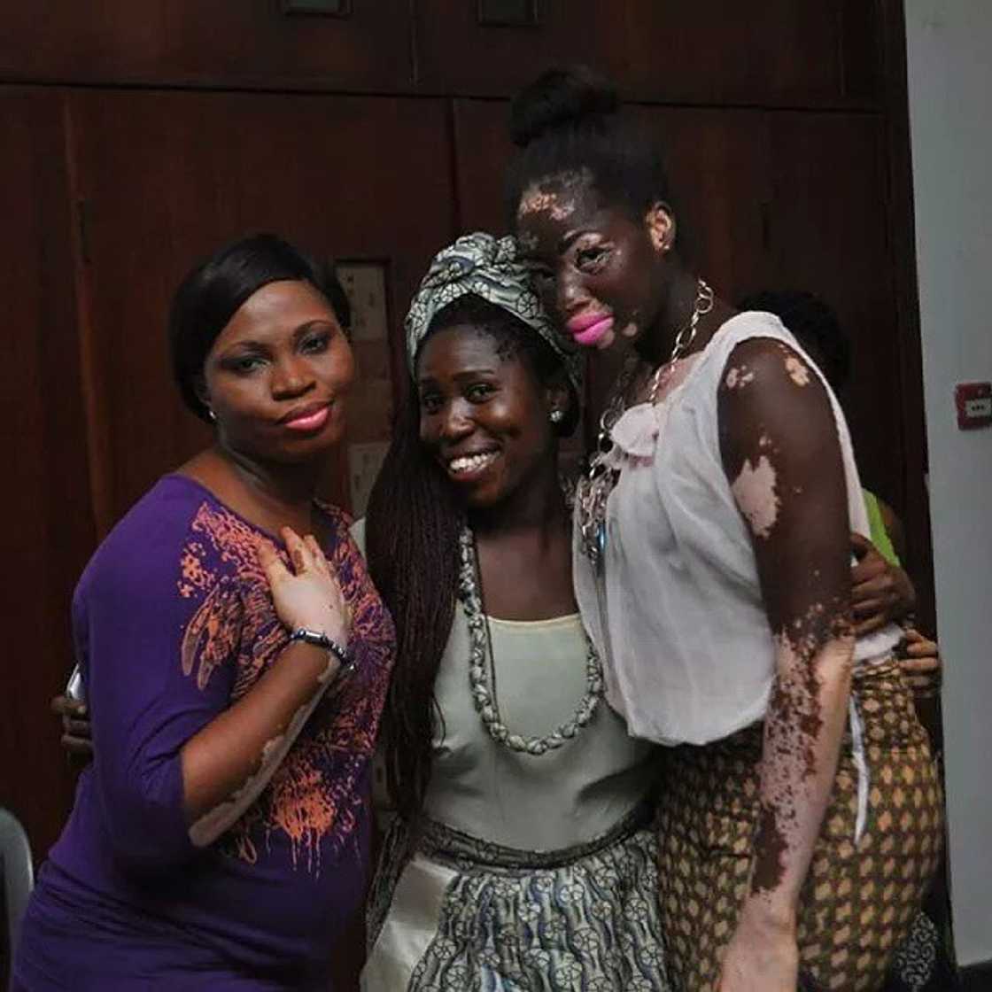 Vitiligo Day Vitiligo Day