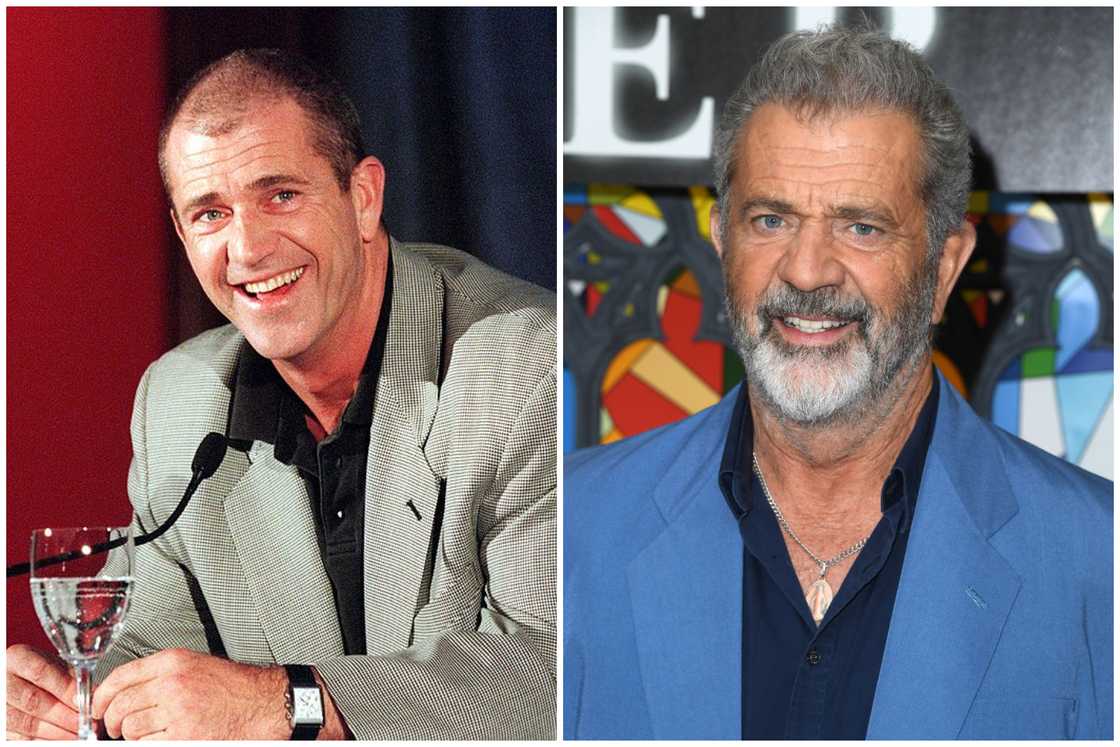 Hair transplant celebrities before and after Hair transplant celebrities before and after