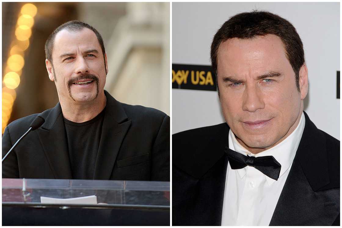 Hair transplant celebrities before and after