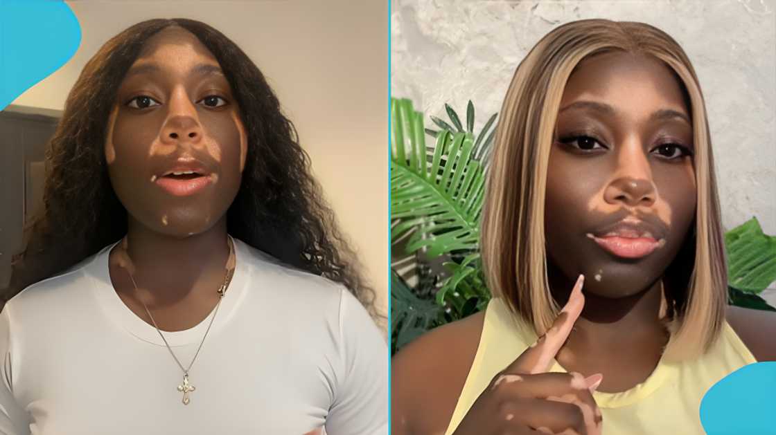 Vitiligo talk, Skin conditions in Ghana, Vitiligo at Tidal Rave, Ghana, Abigail Boateng, Skin pigment, education