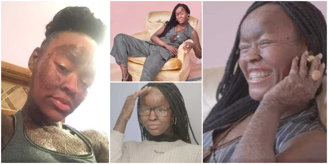 Jeyza: The 21-year-old who sheds skin every 10 days and doesn't sweat Jeyza: The 21-year-old who sheds skin every 10 days and doesn't sweat