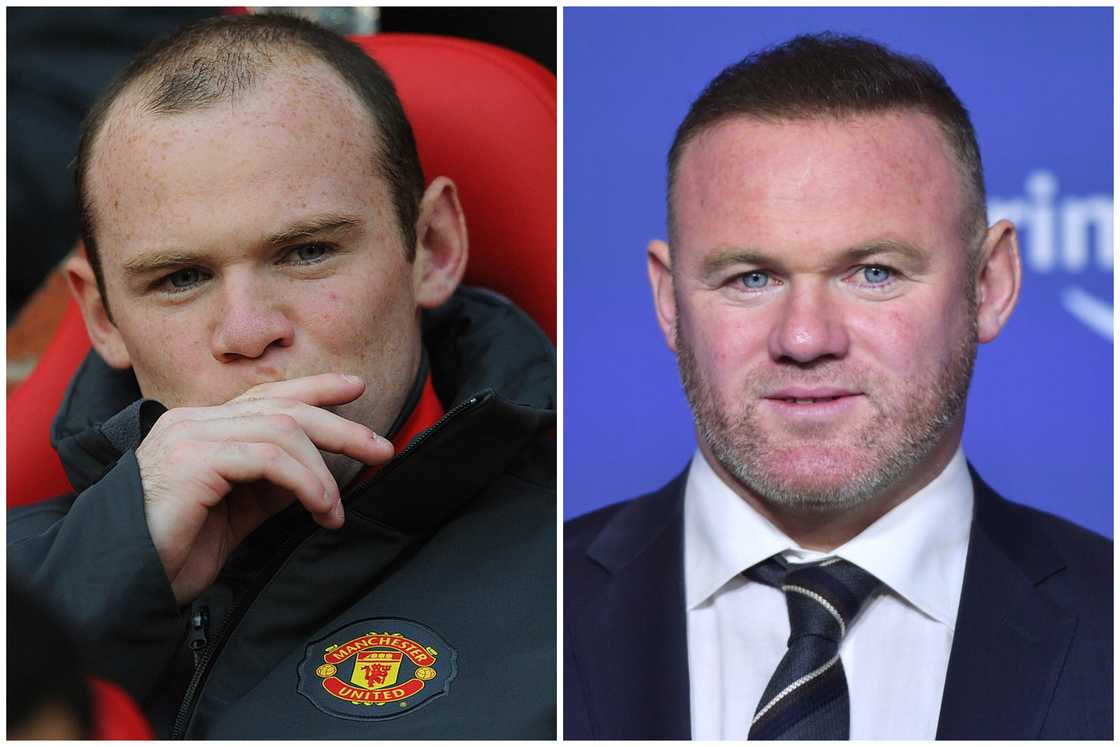 Hair transplant celebrities before and after Hair transplant celebrities before and after