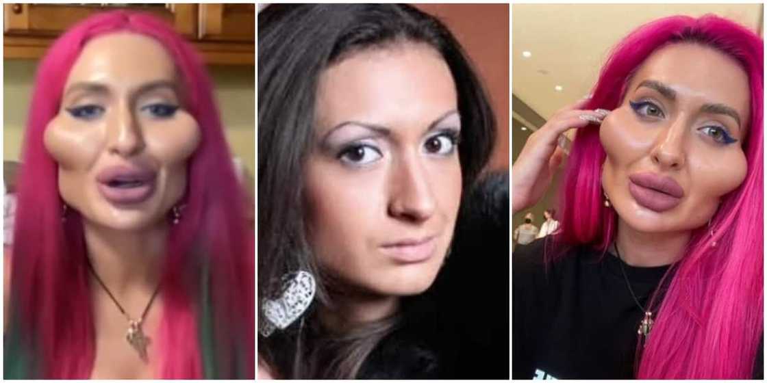 32-year-old lady who spent N904k to pump her cheeks says her former look was ugly 32-year-old lady who spent N904k to pump her cheeks says her former look was ugly