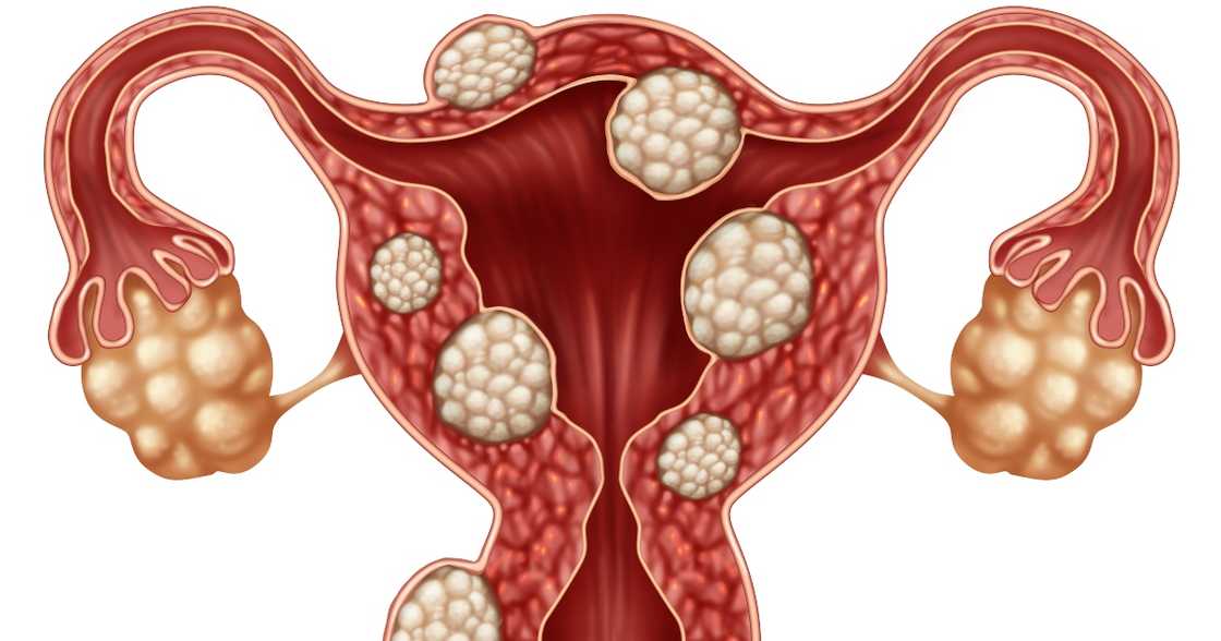 The effect fibroids have on fertility The effect fibroids have on fertility