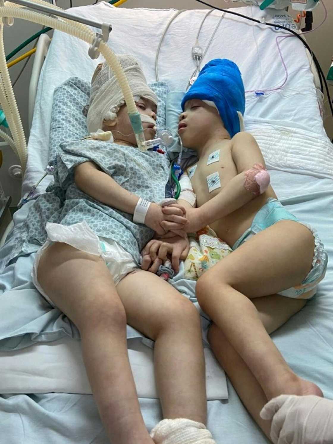 Conjoined twins Bernardo and Arthur Lima got to look each other face to face for the first time after their operation in the Instituto Estadual do Cerebro Paulo Niemeyer (IECPN) hospital in Rio de Janeiro Conjoined twins Bernardo and Arthur Lima got to look each other face to face for the first time after their operation in the Instituto Estadual do Cerebro Paulo Niemeyer (IECPN) hospital in Rio de Janeiro