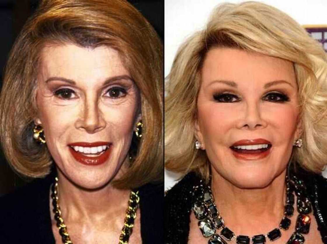 Celebrity blepharoplasty before and after