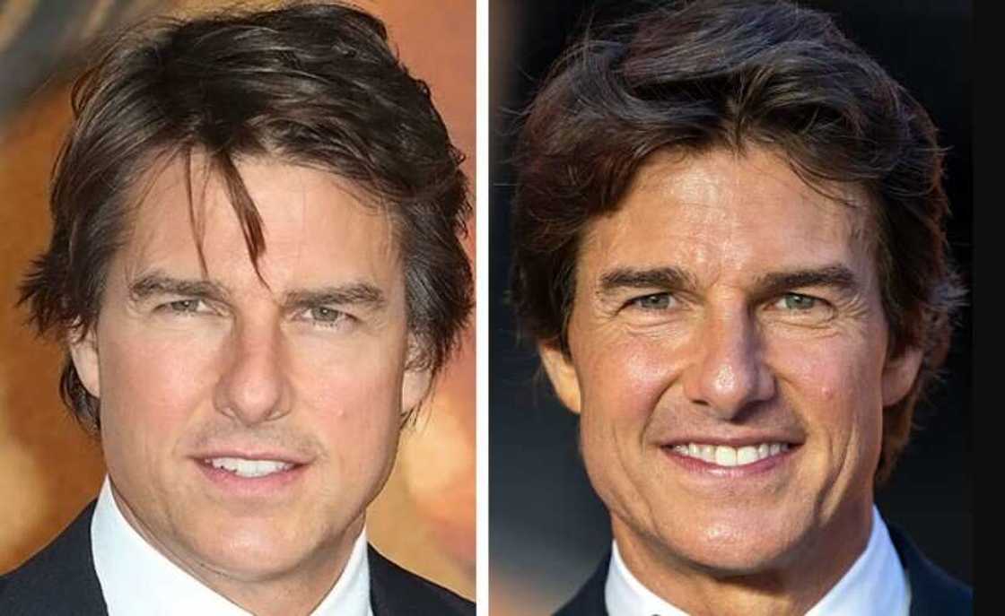 Celebrity blepharoplasty before and after Celebrity blepharoplasty before and after