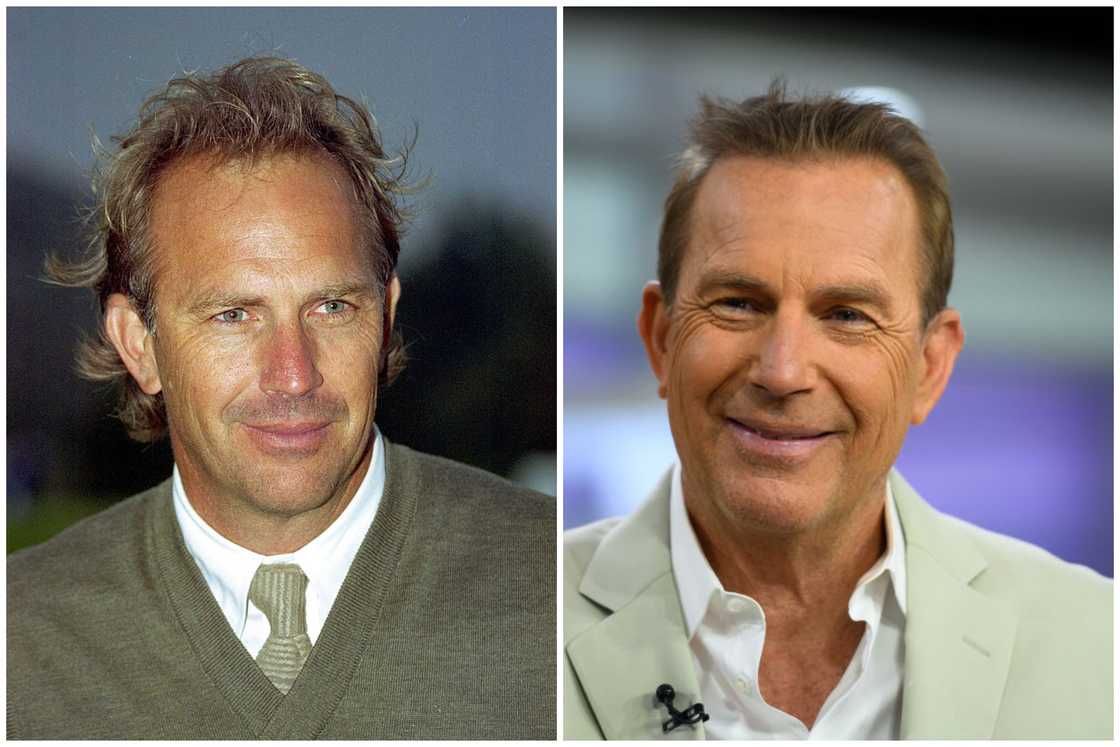 Hair transplant celebrities before and after