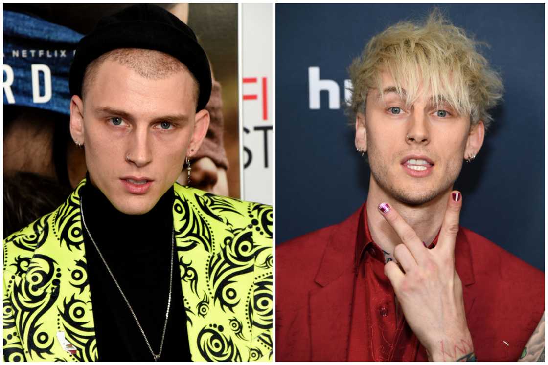 Hair transplant celebrities before and after Hair transplant celebrities before and after