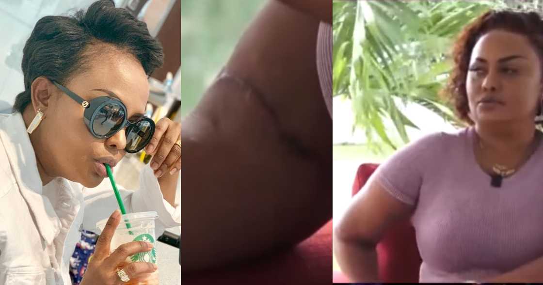 Nana Ama McBrown: Actress Shows Broken arm which was Replaced with Metal Nana Ama McBrown: Actress Shows Broken arm which was Replaced with Metal