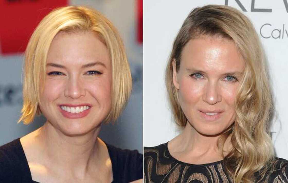 Celebrity blepharoplasty before and after Celebrity blepharoplasty before and after