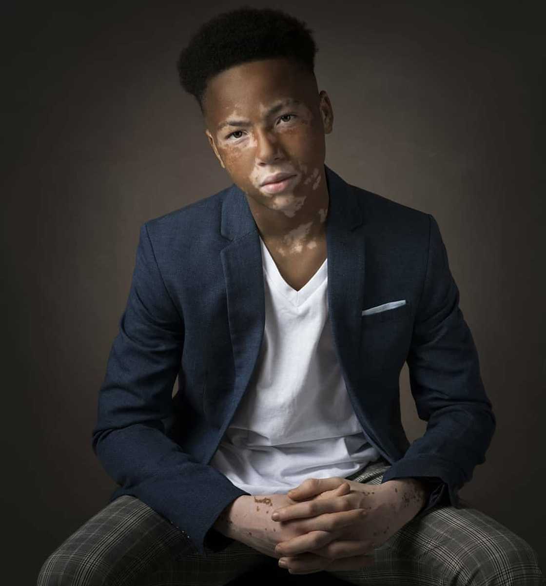 Vitiligo Day Vitiligo Day