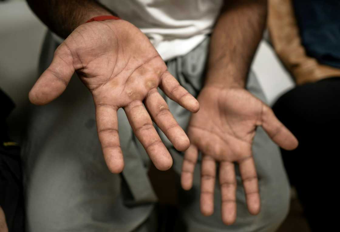 Many migrants have infectious dermatological diseases Many migrants have infectious dermatological diseases