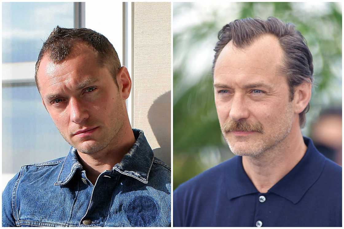 Hair transplant celebrities before and after Hair transplant celebrities before and after