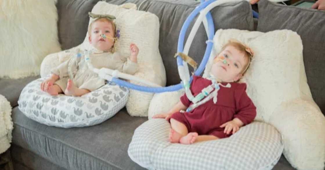 They were separated successfully after a 10 hours surgery. They were separated successfully after a 10 hours surgery.