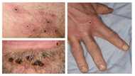 WHO emergency committee meets on monkeypox