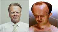 Who has the biggest forehead in the world? Everything you need to know