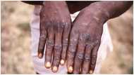 Monkeypox cases shoot up to 18 in Ghana – GHS reveals