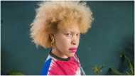 Albinism Awareness Day: 5 Ghanaian myths & 6 facts about skin condition