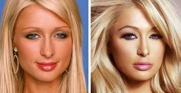 Celebrity blepharoplasty before and after: 10 celebrities that have had