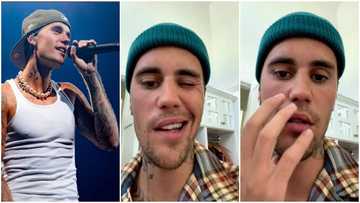 Justin Bieber diagnosed with Ramsay Hunt syndrome that causes partial facial paralysis, hearing loss