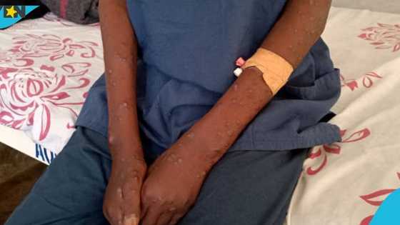 Ghana's Mpox cases hit 133 after 14 new cases were recorded