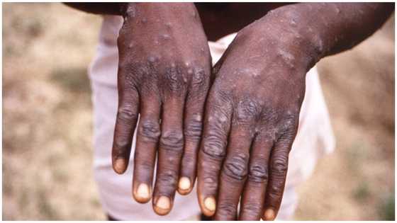 Monkeypox cases shoot up to 18 in Ghana – GHS reveals