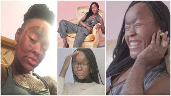 Meet pretty 21-year-old lady whose skin sheds every 10 days, she doesn't sweat at all