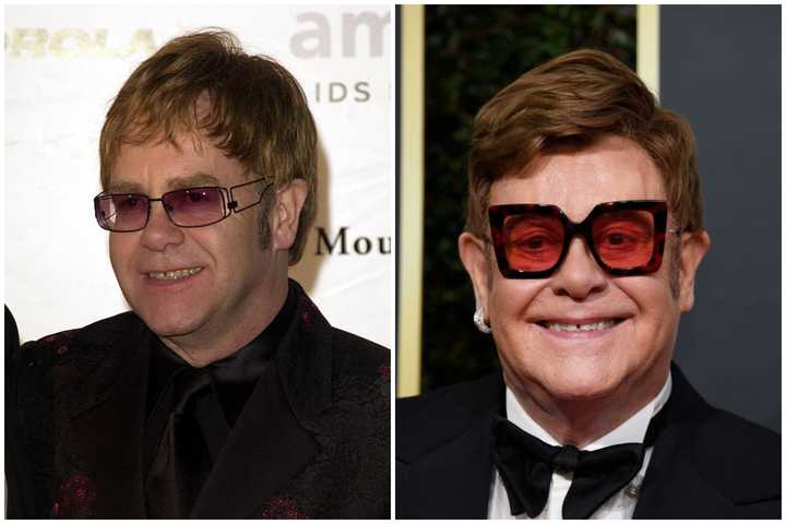 25 Male Hair Transplant Celebrities Before And After (with Photos 